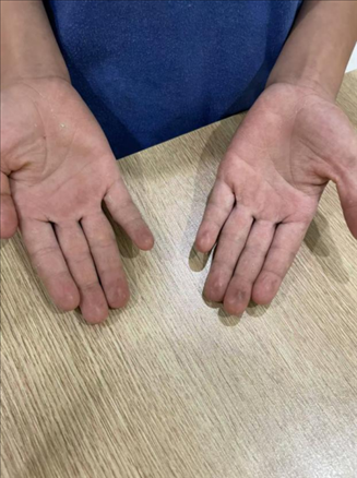 9歲小學(xué)生長(zhǎng)期拍煙卡，手部粗糙長(zhǎng)繭。受訪者供圖